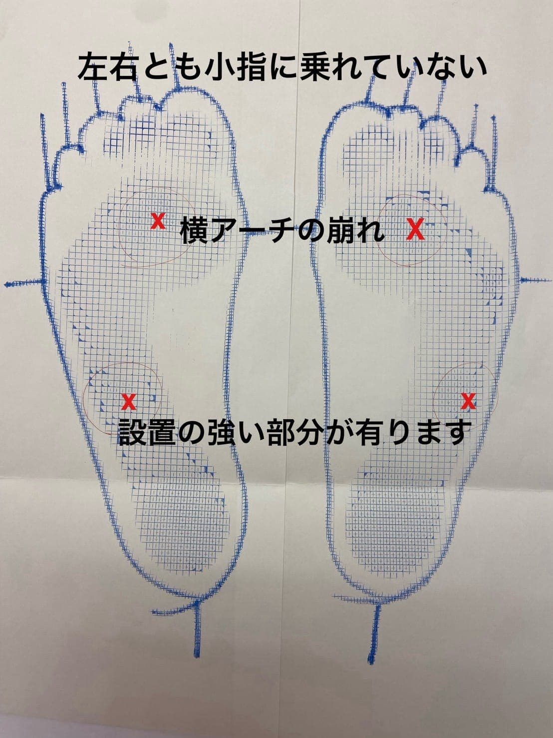 足型から横アーチの崩れや荷重の偏りを書き込んだ分析シート